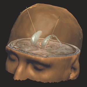 Implantation des électrodes dans le cerveau