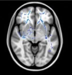 IRM de diffusion : les marques bleues traduisent une plus forte densité axonale chez les HP que chez les personnes à intelligence moyenne. Ici chez des haut-potentiel à profil homogène.