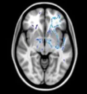 Les haut-potentiel avec un profil hétérogène, c’est-à-dire bien meilleurs dans les tests d’intelligence verbale que dans ceux mesurant l’intelligence non-verbale, montrent une forte asymétrie en faveur de l’hémisphère gauche. D’après Nusbaum et al., 2017.