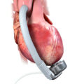 Pompe CorWave implantée dans le coeur.