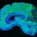 Capitaliser sur la richesse des informations fournies par les images cérébrales pour lutter contre les maladies neurodégénératives