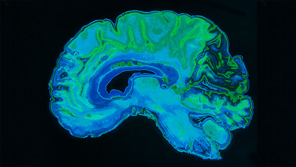 Capitaliser sur la richesse des informations fournies par les images cérébrales pour lutter contre les maladies neurodégénératives