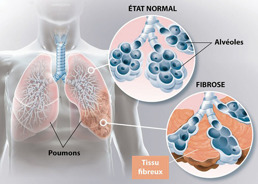 Fibrose pulmonaire